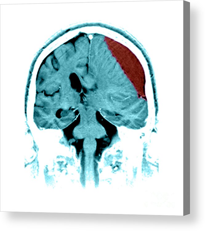 A Global Neurosurgery Approach to Reducing the Burden of Traumatic Acute Subdural Hematoma: A Narrative Review