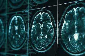 Stuti Chakraborty proposes the GOLDEN TRIAD OF EPD: Early Prevention and Detection in Stroke (Part 1)