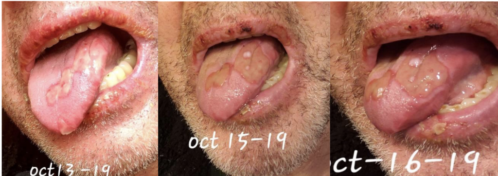 Edition 67 –Timeline in Pictures of Oral Aphthae as a Presenting Symptom for Behcet’s Disease